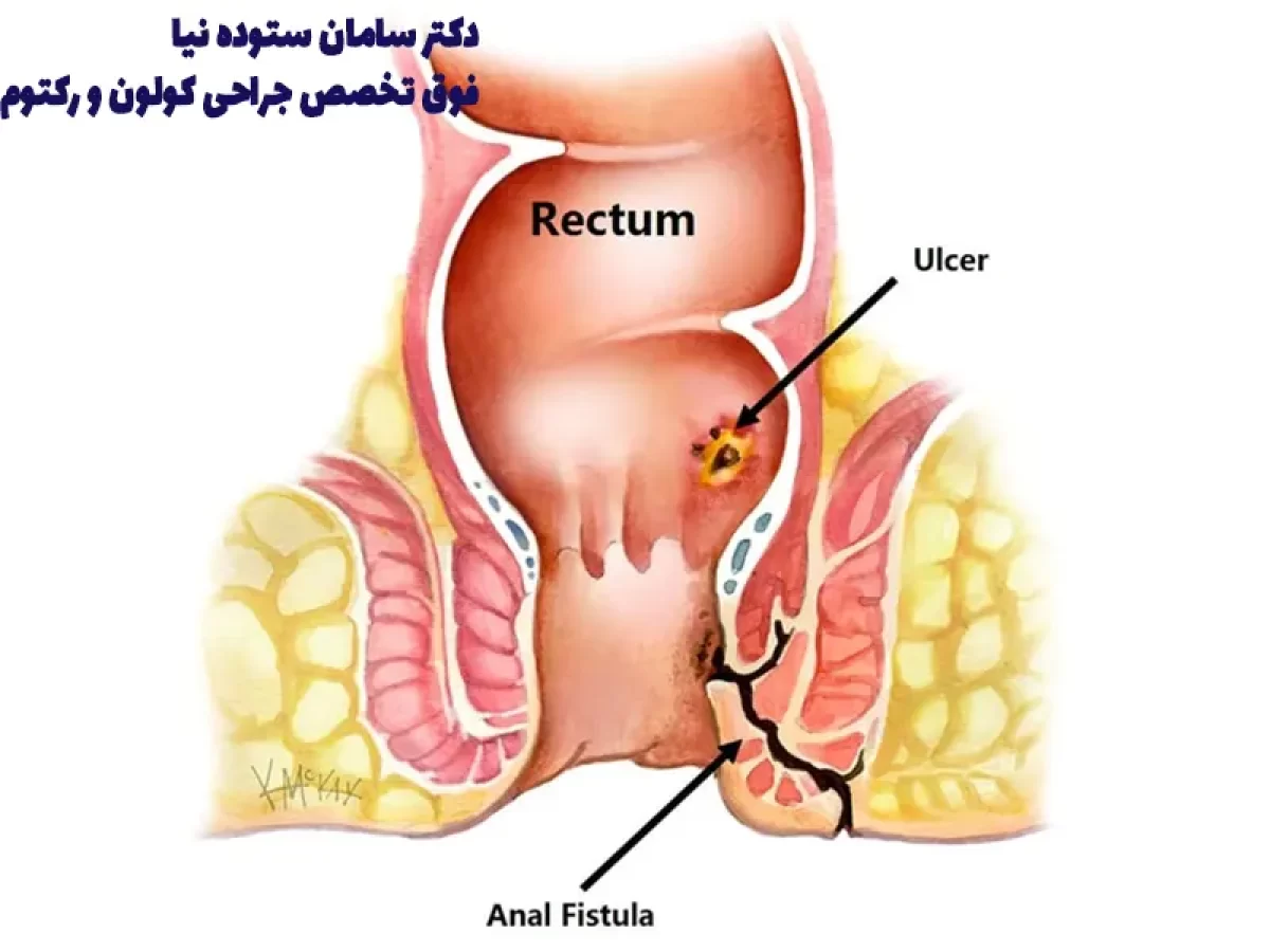 فیستول بایگانی - دکتر ستوده نیا