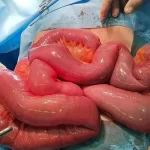 پیچ خوردن روده
