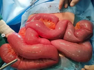 پیچ خوردن روده