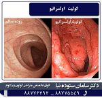 کولیت اولسراتیو