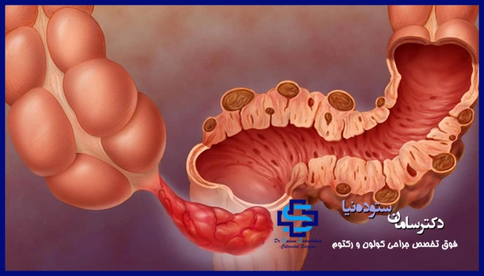 دیورتیکول چیست