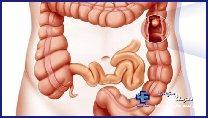 شایع ترین علت انسداد روده