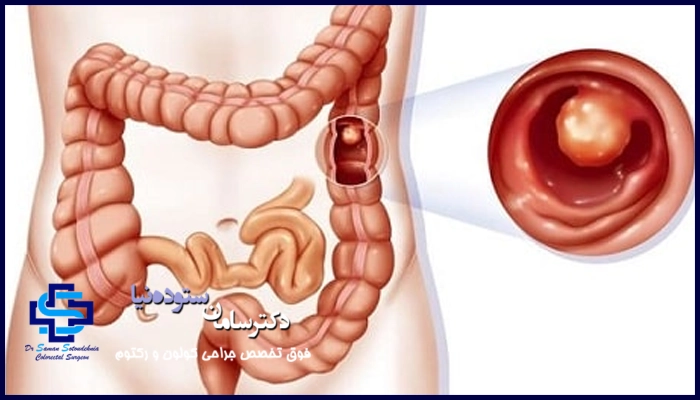 زخم روده چه علائمی دارد؟