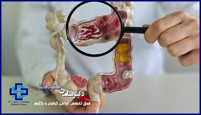 علائم کولیت زخمی